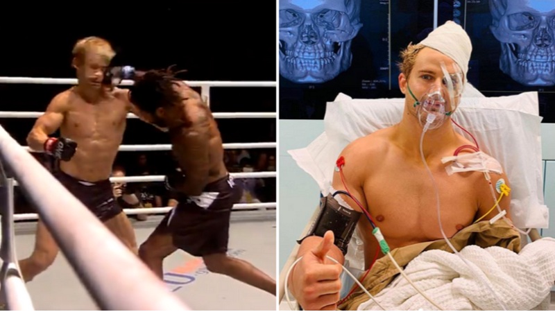 够狠！前UFC新星诺斯卡特脸被打8处骨折、碎成30多块