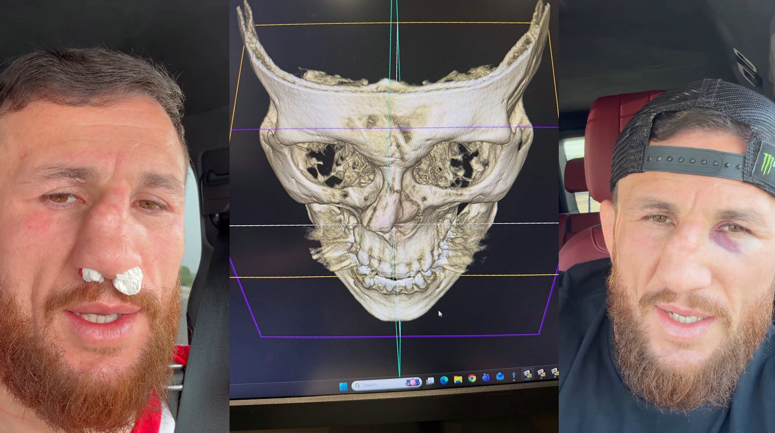 前UFC冠军梅拉布·德瓦利什维利鼻子骨折拒绝手术治疗
